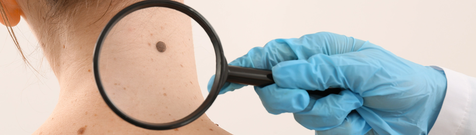 Skin health awareness of a magnifying glass examination of a mole.